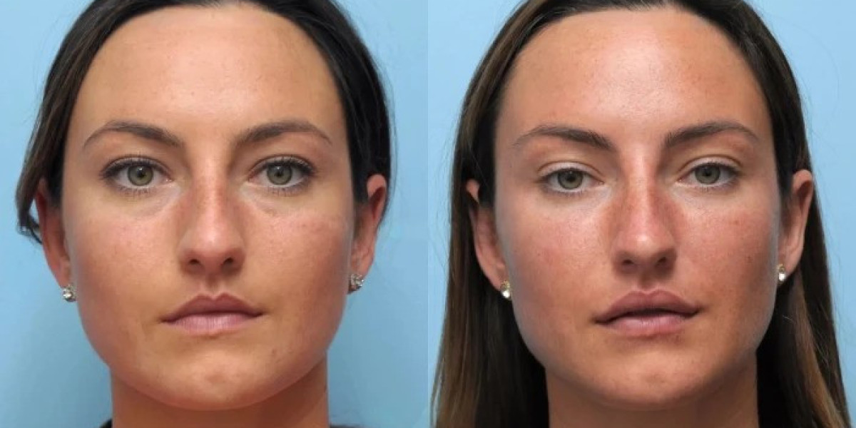Best Plastic Surgeon in Dubai: Advanced Thread Lift Treatments for Beautiful Skin