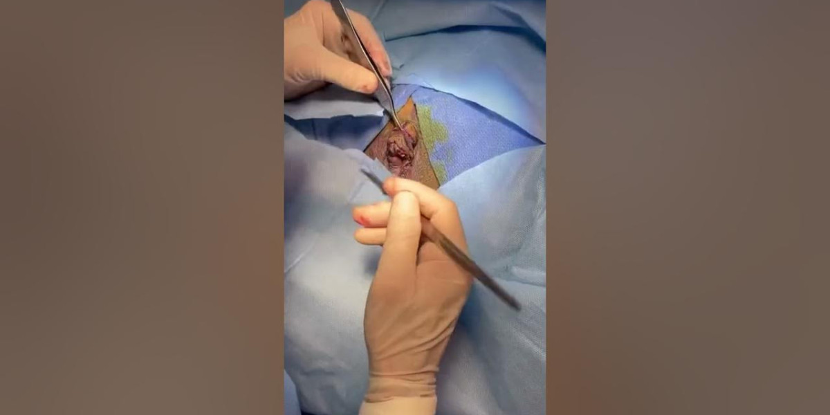 Labiaplasty for Comfort and Confidence Riyadh