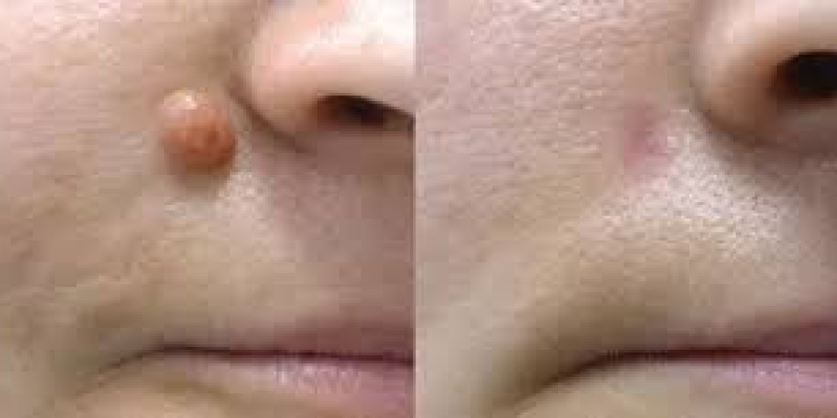 Professional Skin Care and Mole Removal in Dubai for Clear and Healthy Skin