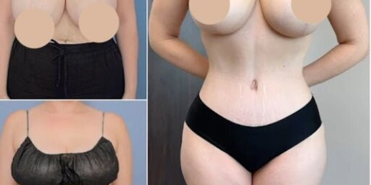 Refine Your Body Shape with Professional Tummy Tuck in Dubai