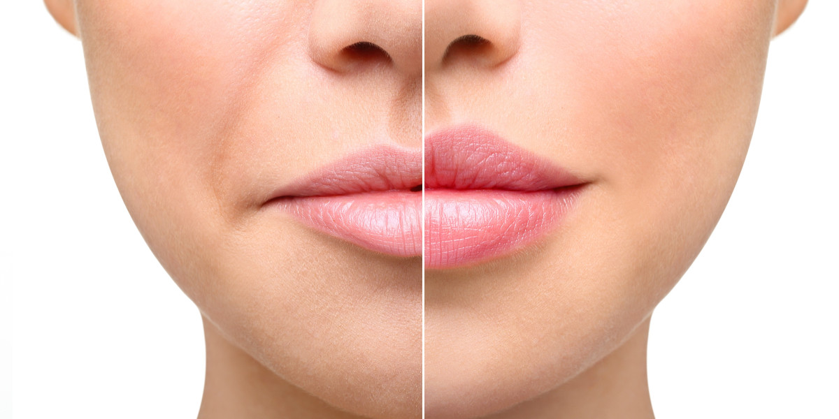 How to Fix Uneven Lip Proportions with Dermal Fillers
