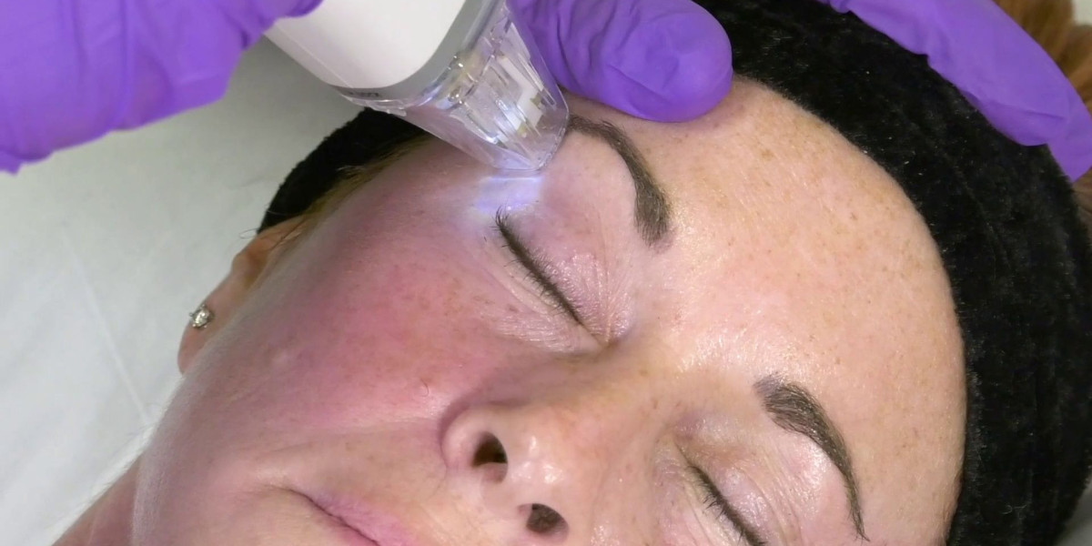Fractional RF Microneedling in Dubai Recovery Guide
