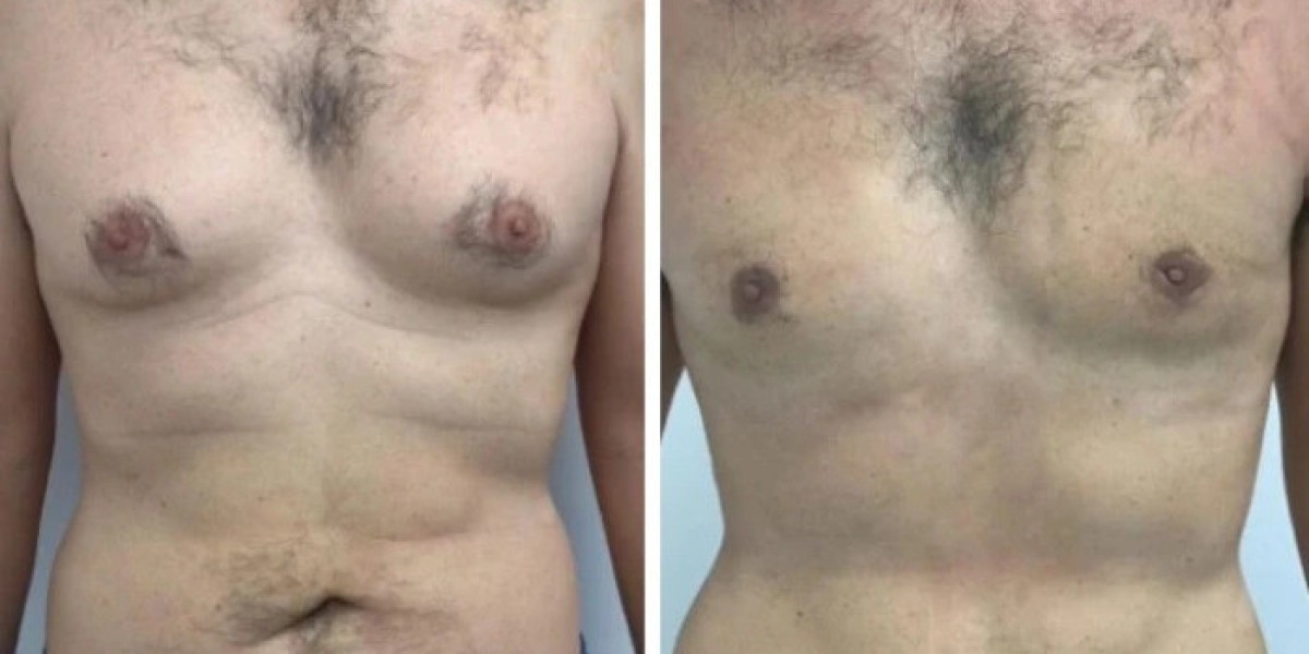Gynecomastia Surgery in dubai Building Self Esteem After Successful Treatment