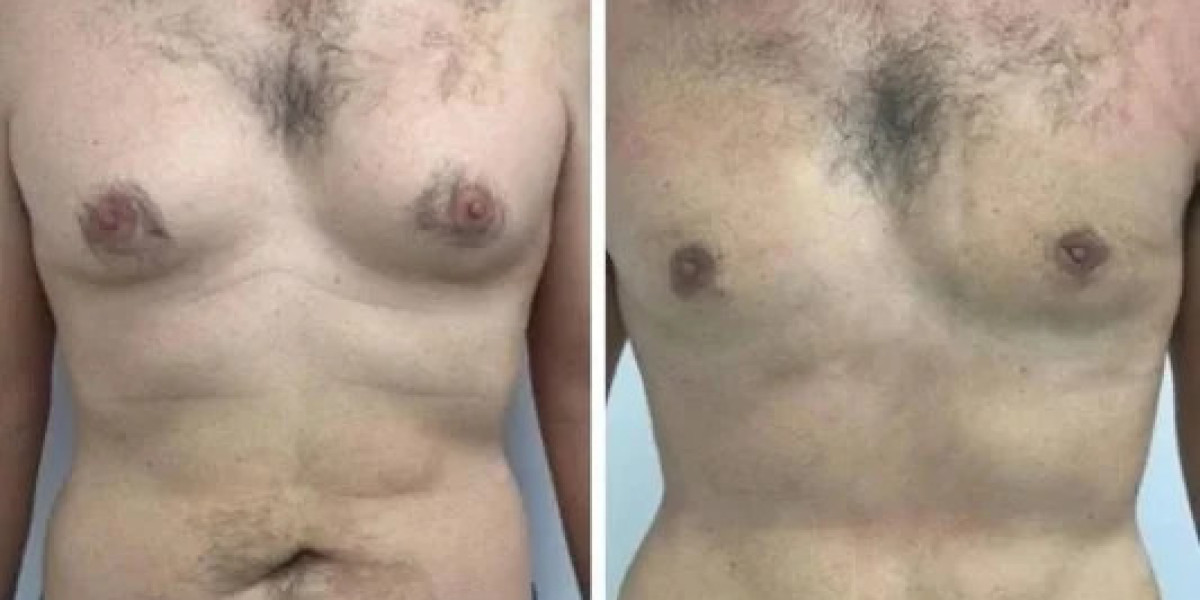 Best Gynecomastia Surgeons in Dubai: The Growing Demand for Male Cosmetic Surgery