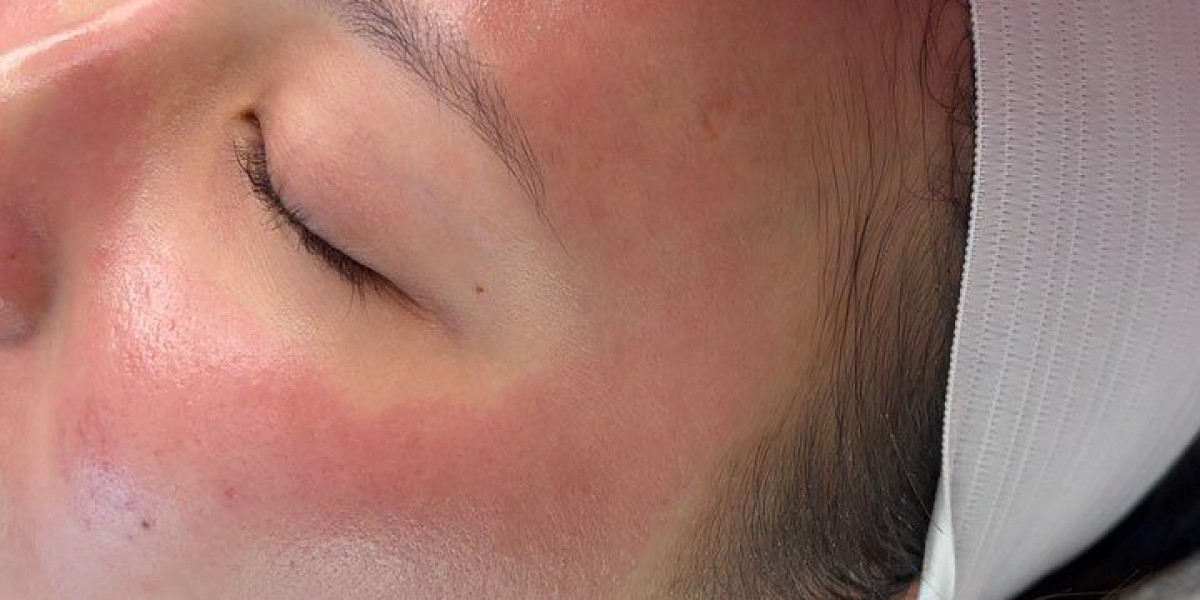 Microneedling with PRP in Dubai for Fine Lines