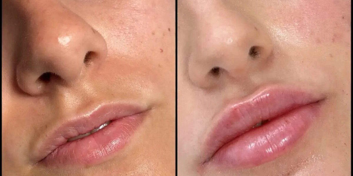 Fillers Treatments in Dubai for Facial Symmetry and Balance