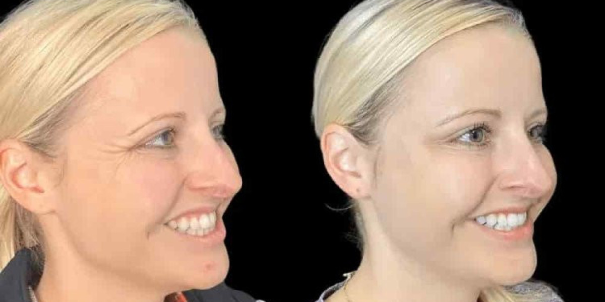Best Aesthetic Clinic in Dubai for Botox for Refined Facial Contours