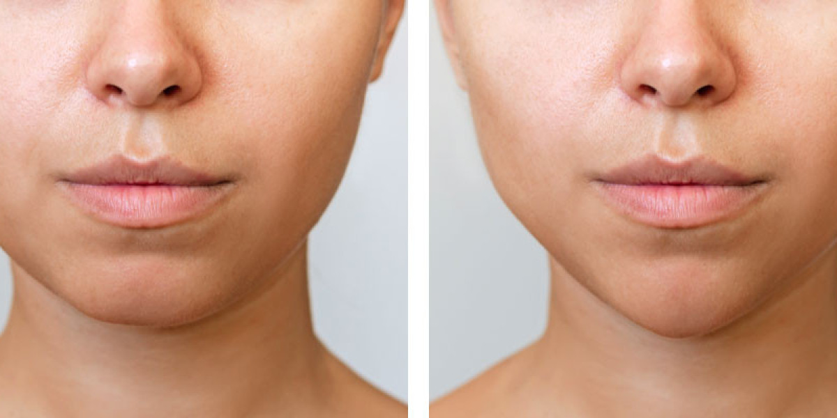How Chin Reduction Surgery Transforms Your Facial Profile
