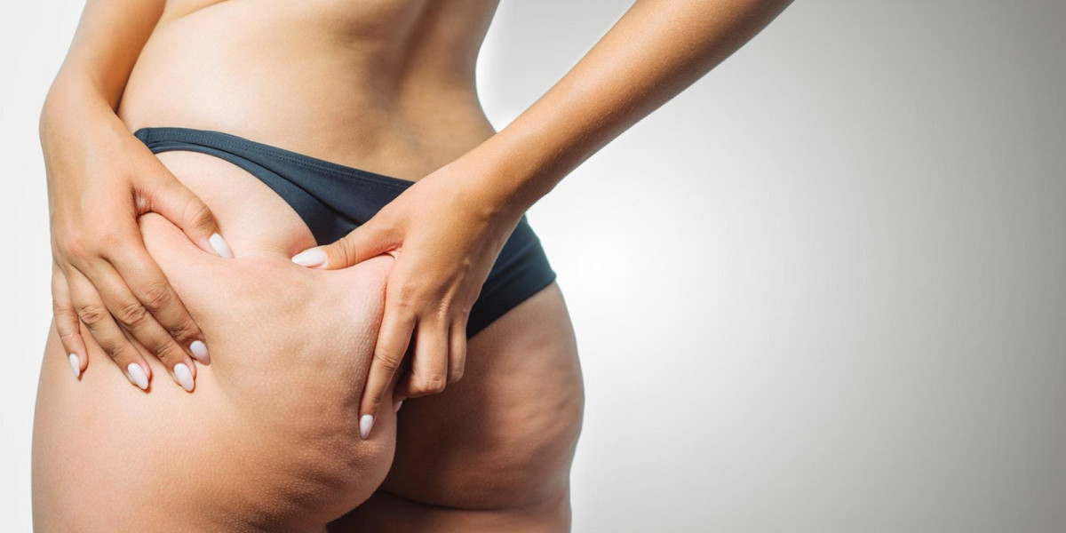 Can Cellfina Treatment Reduce Stubborn Cellulite?