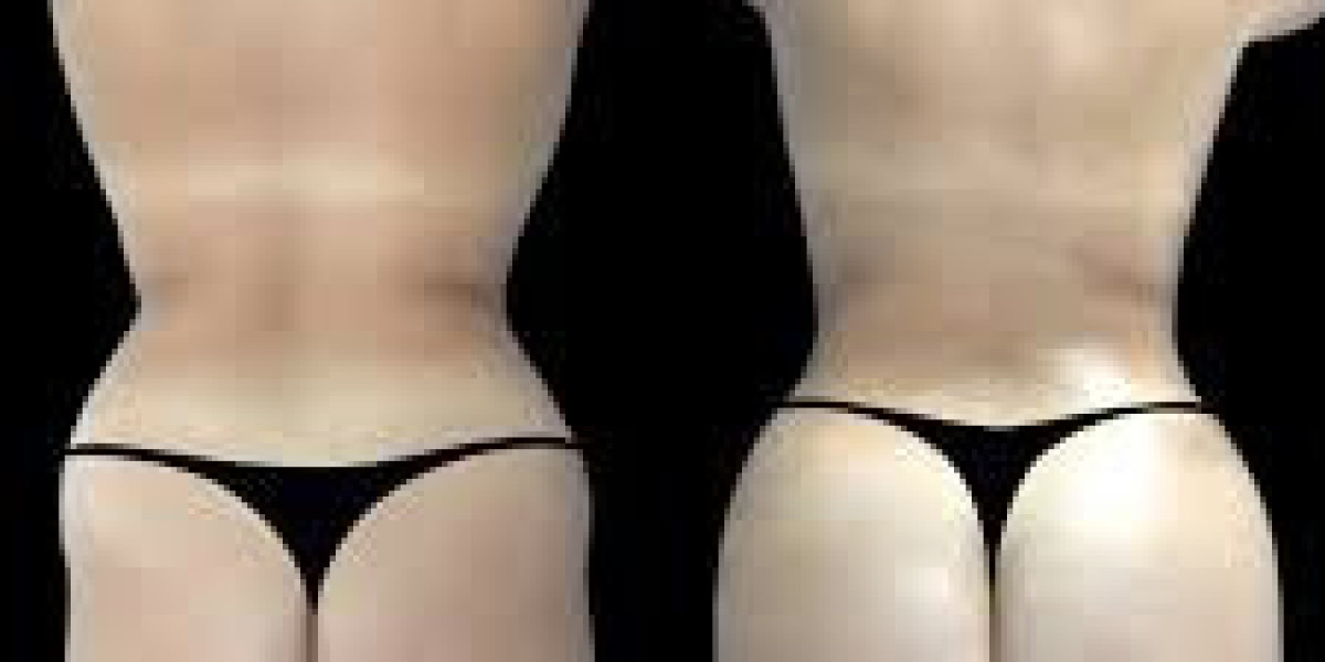 Butt Fat transfer in Dubai: How to Research a Cosmetic Surgery Clinic
